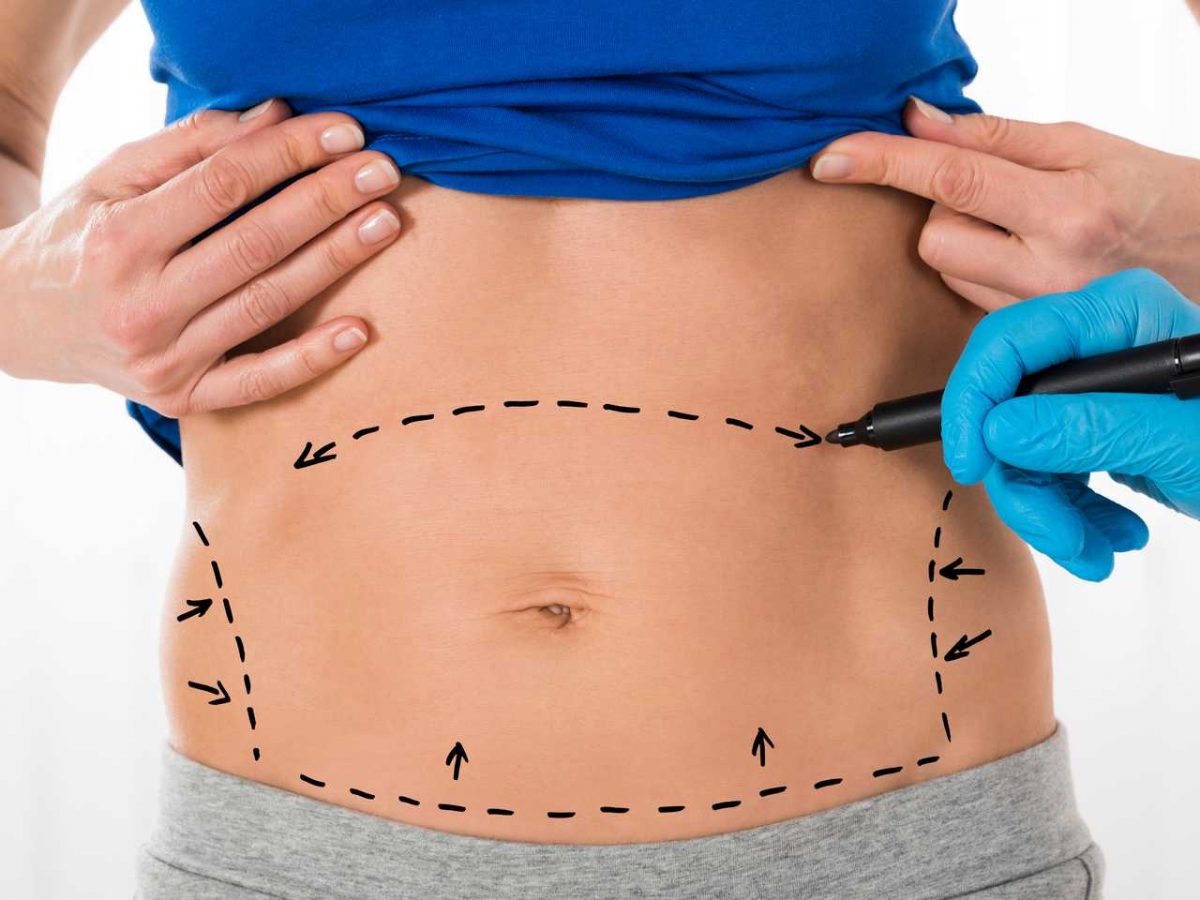 3Liposuction-1200x900.jpg