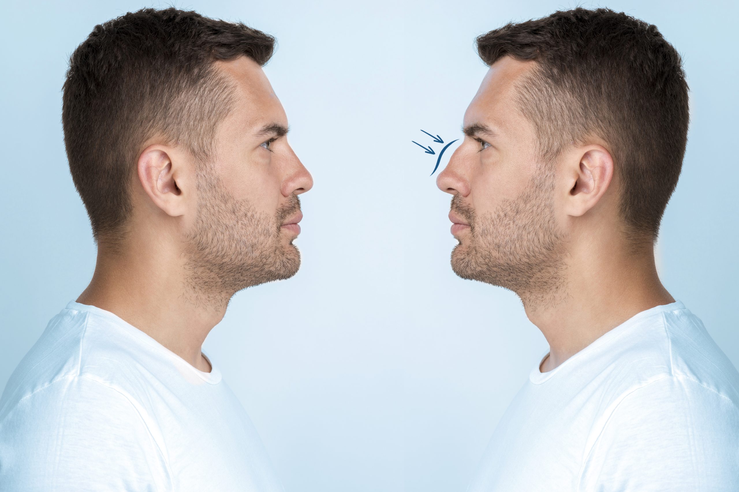 Rhinoplasty in Egypt: Reshape Your Nose with the Best Cosmetic Surgeon